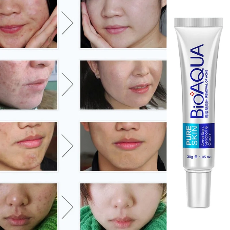 

BIOAQUA 30g Acne Treatment Blackhead Removr Anti Acne Cream Face Essence Shrink Pores Acne Scar Remove Face Care Whitening