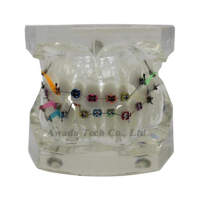 Стоматологии Ортодонтическое модели Стоматологическая модель Кронштейн