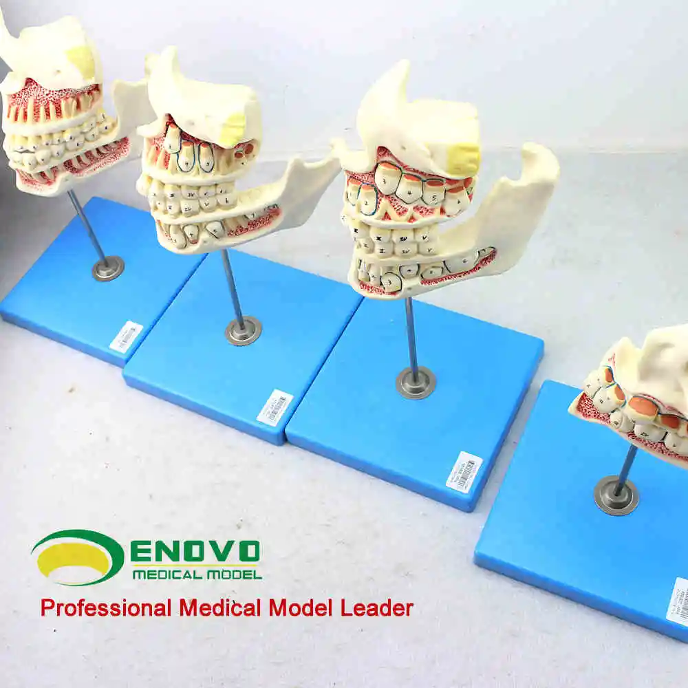

Child tooth and jaw development model tooth decayed teeth tooth health model