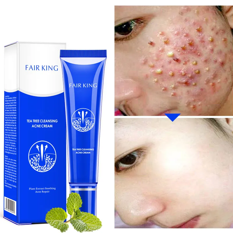 Tea Tree крем для очищения от акне кистозного быстрого действия лица тяжелой |