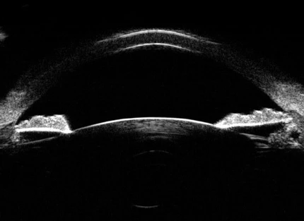 Микроскоп для ультразвуковой биомикроскопии с ультразвуковым