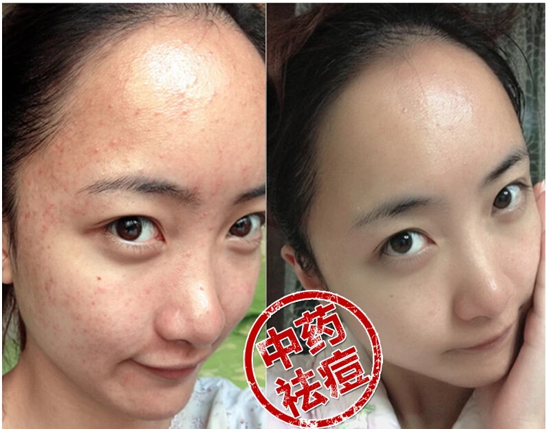 Крем для лица быстродействующий латунный антивоспалительный крем удаления