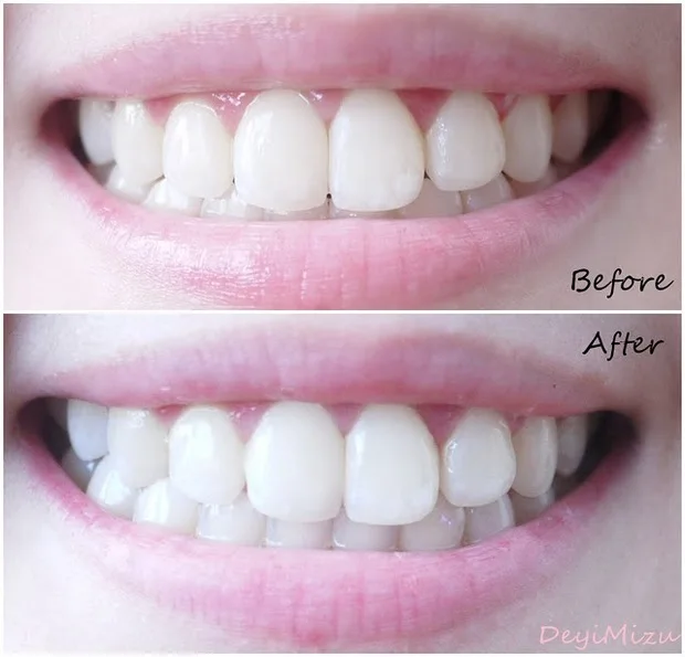 10 Сумки 20 полоски crest whitestrips 3D Расширенный яркие Luxe Гламурная отбеливающие для