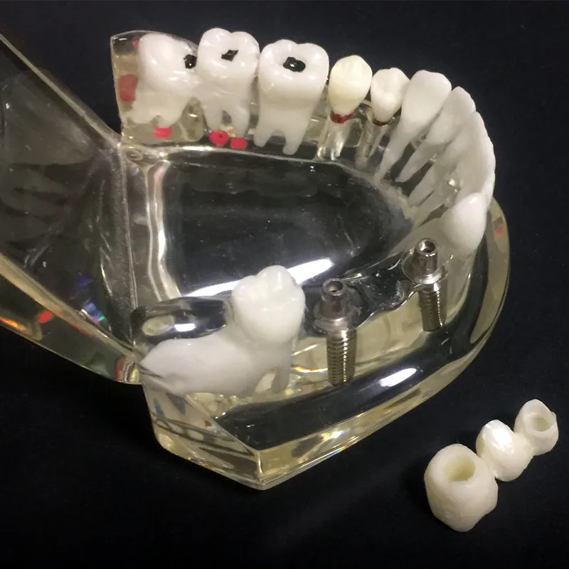 Модель зубного имплантата модель зубов с мостом для восстановления малокклюзия