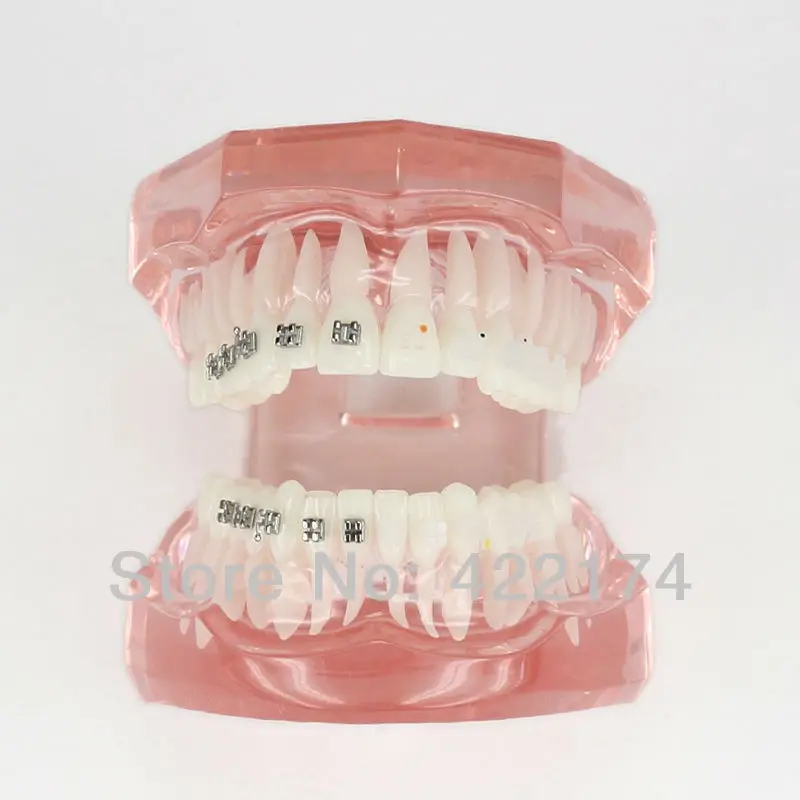 Бесплатная доставка полуметаллическая металлическая модель ортодонтики