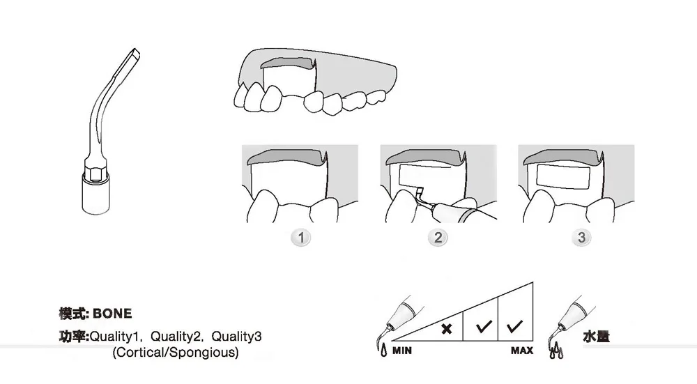 3 шт. US3 FIT дятел, Mectron basic scalpel OT2 для стоматологического инструмента