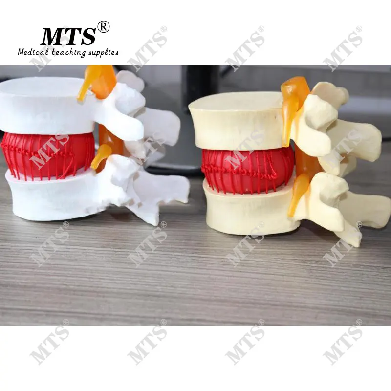 Человеческая планшетологическая герниация обучающая модель медицинский