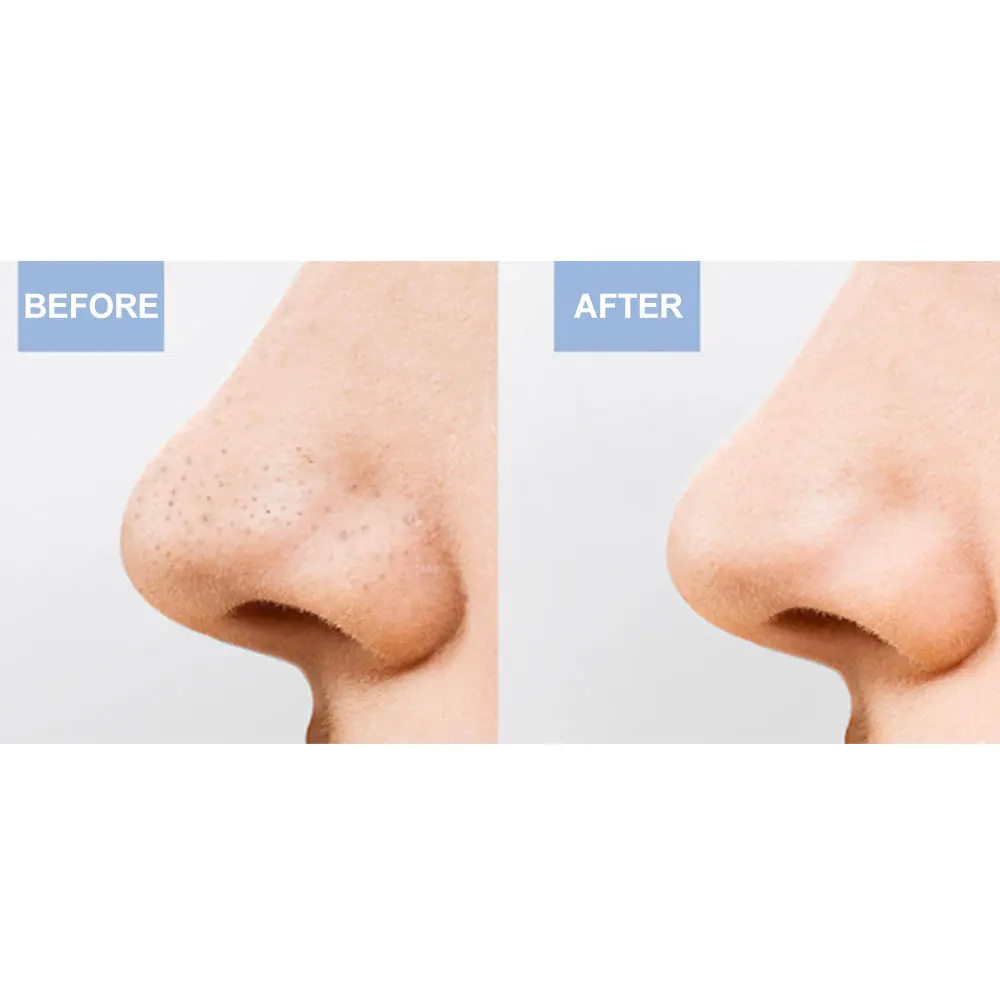 Vacuum Acne Cleanser Effective Blackhead Remover Multifunction Lipstick Pore Cleaner Nose Deep Cleaning Treatment | Красота и
