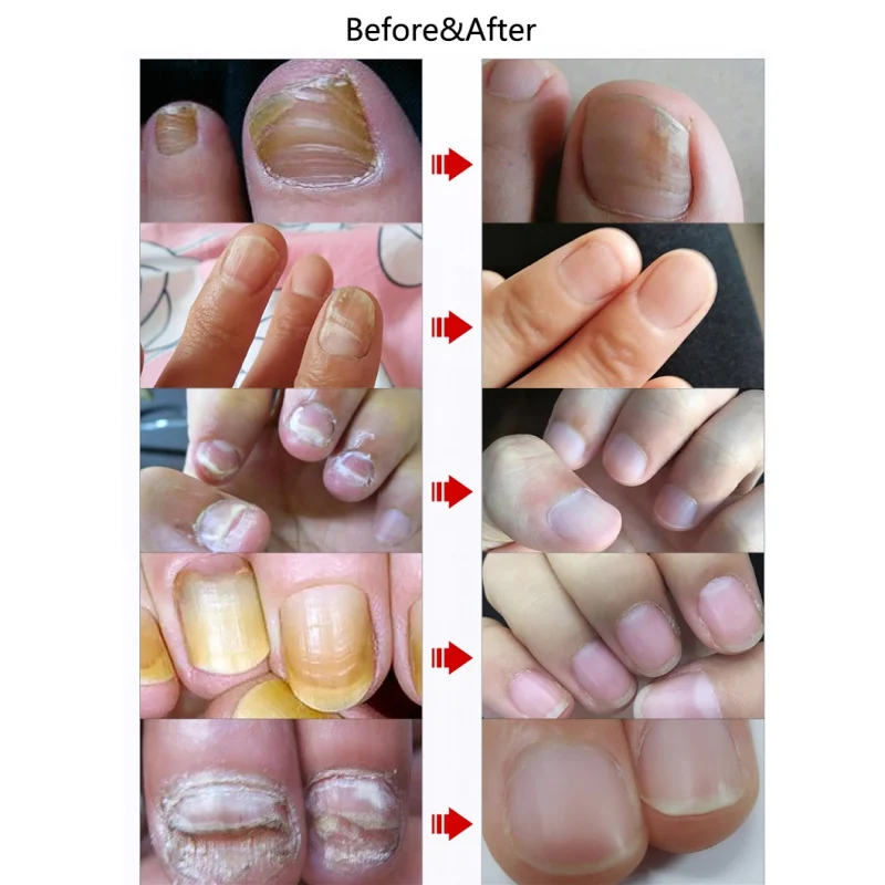 

30ml Onychomycosis Fungal Treatment Nail Foot Whitening Toe Nail Fungus Removal Gel Nail Treatment Feet Care Essence Oil