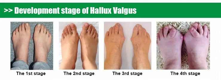 Новые силиконовые корректор для пальцев ног toe hallux вальгусные подтяжки ортопедические носки ортопедические ежедневно бандаж на палец Уход за ногами
