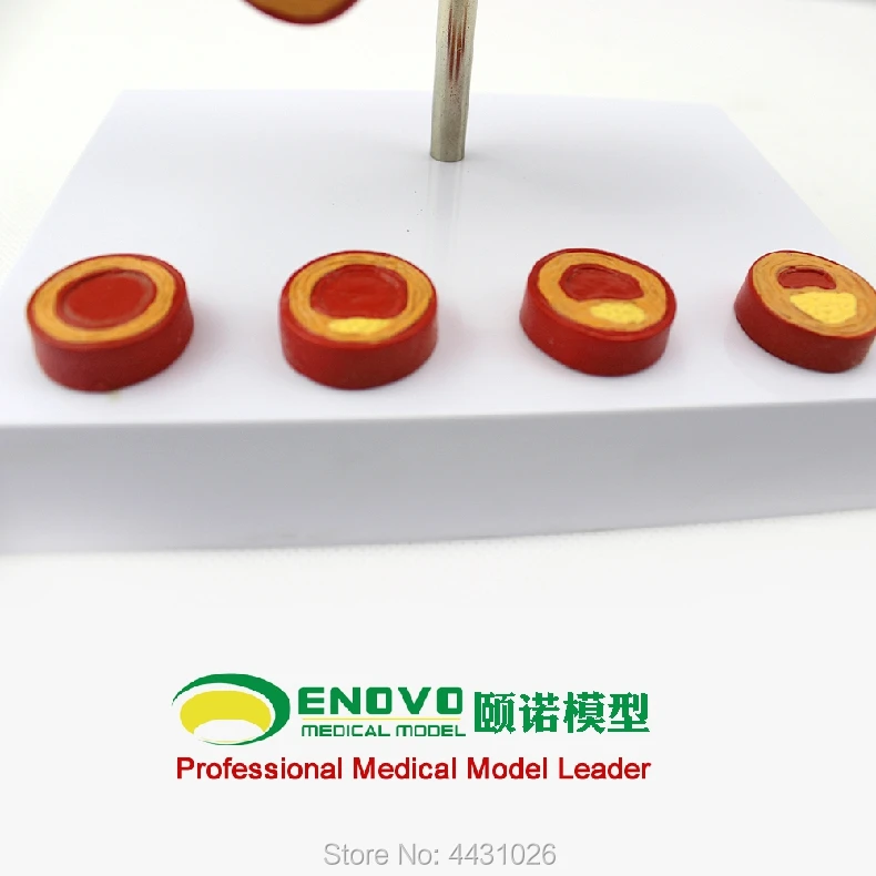 

ENOVO Coronary arterial arteriosclerosis model elderly heart model thrombus cardiology
