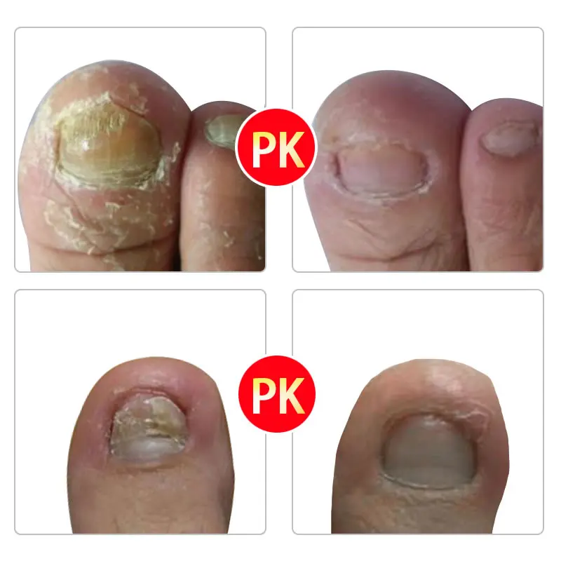 

Fungal Nail Infection Remover Foot Fungus Treatment Toenail Athlete Free Ship