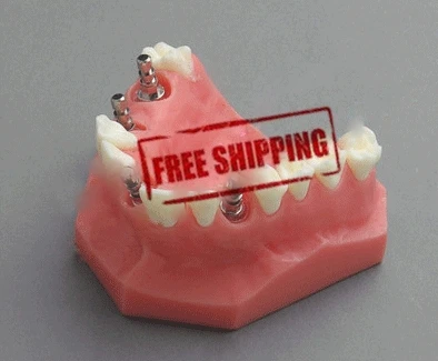 Бесплатная доставка модель импланта стоматологический зуб стоматолог