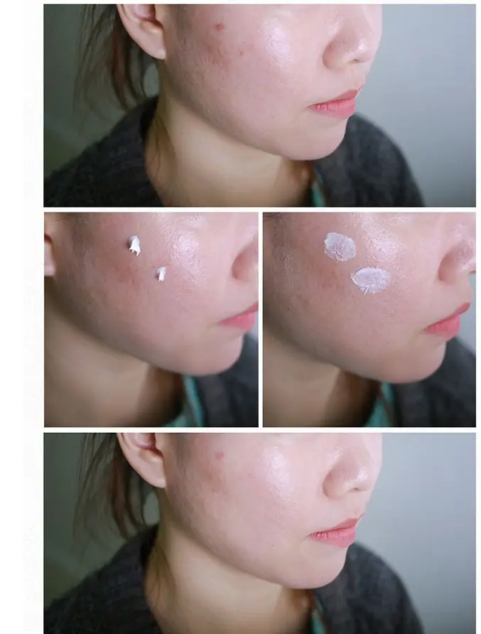 Cosrx Centella крем блемиш 30 мл шрам от акне удаление ухода за кожей лечение усадка пор