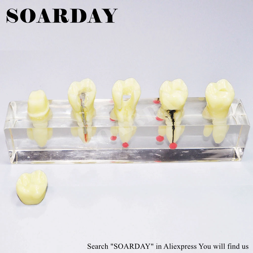 SOARDAY реставрация корневого канала зуба модель оральных стоматологических