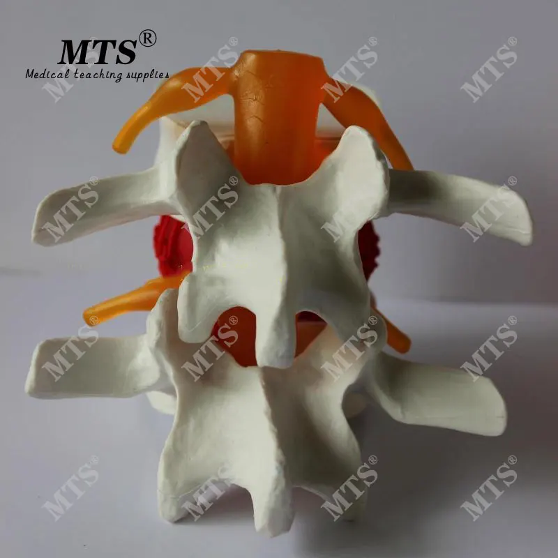 Человеческая планшетологическая герниация обучающая модель медицинский