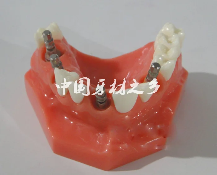 Continental implant tooth model with Planting nail teaching appliance free shipping