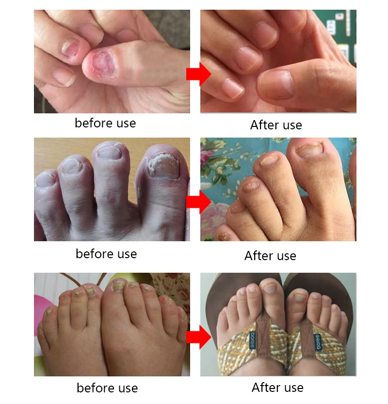 EFERO Nail Repair Essence Serum Toe Nail Fungus Onychomycosis Removal Treatment Nail Care Essence Anti Fungal Nails Repair Cream