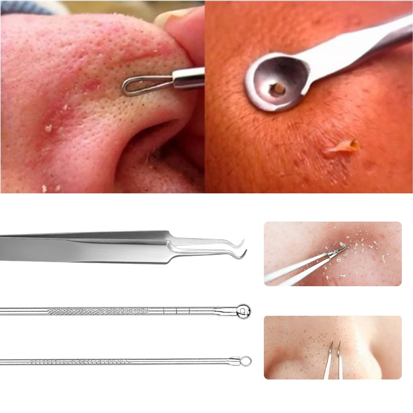 3 шт. Пинцет для удаления угрей из нержавеющей стали лица прыщей пятна comedone extractor