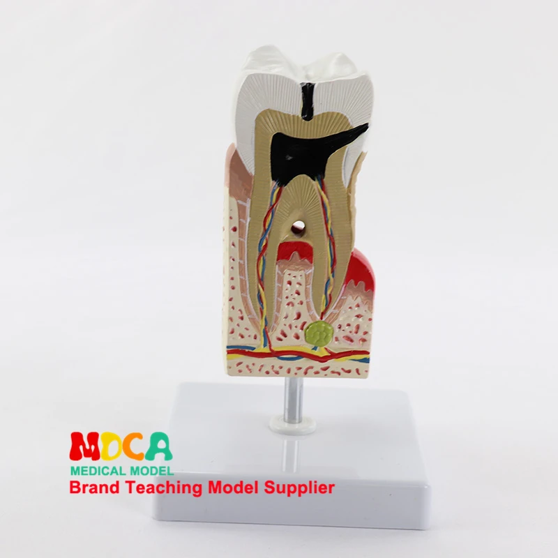 

Dental anatomy model, tooth enlargement, tooth decay, gingival display, medical teaching model MYC010