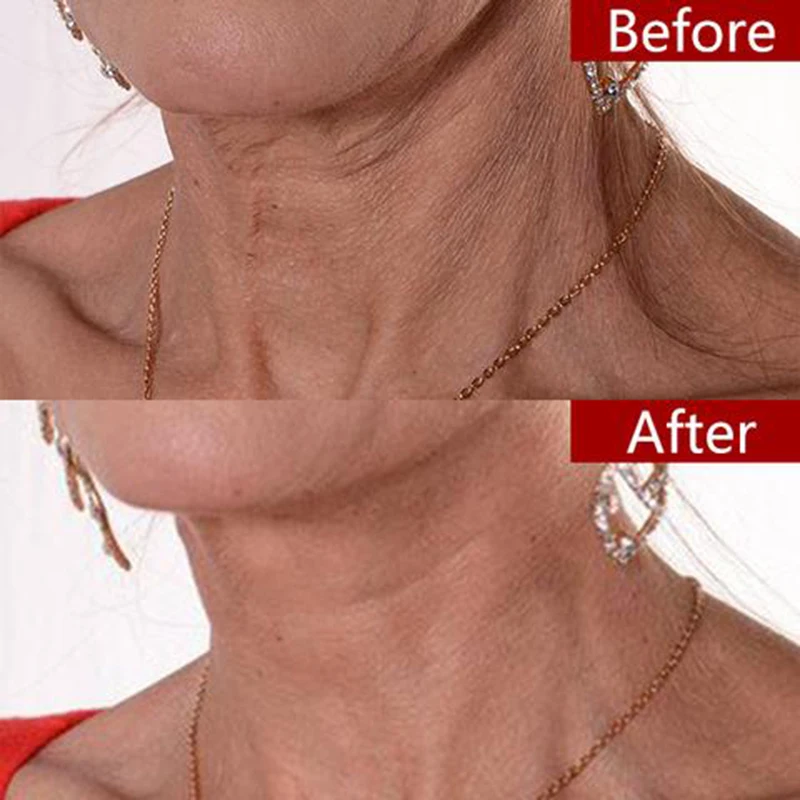 Многоразовые силиконовые уход за шейной ленты шеи морщин тормозные колодки для