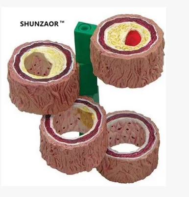 Кровеносный сосуд упрочнение артерий модель артериосклероза анатомическая