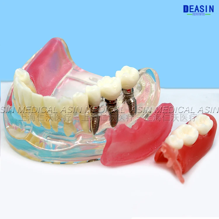 1 pc x high quality Resin Coverage dental implant model dentures Removable teeth for dentist study Deasin |
