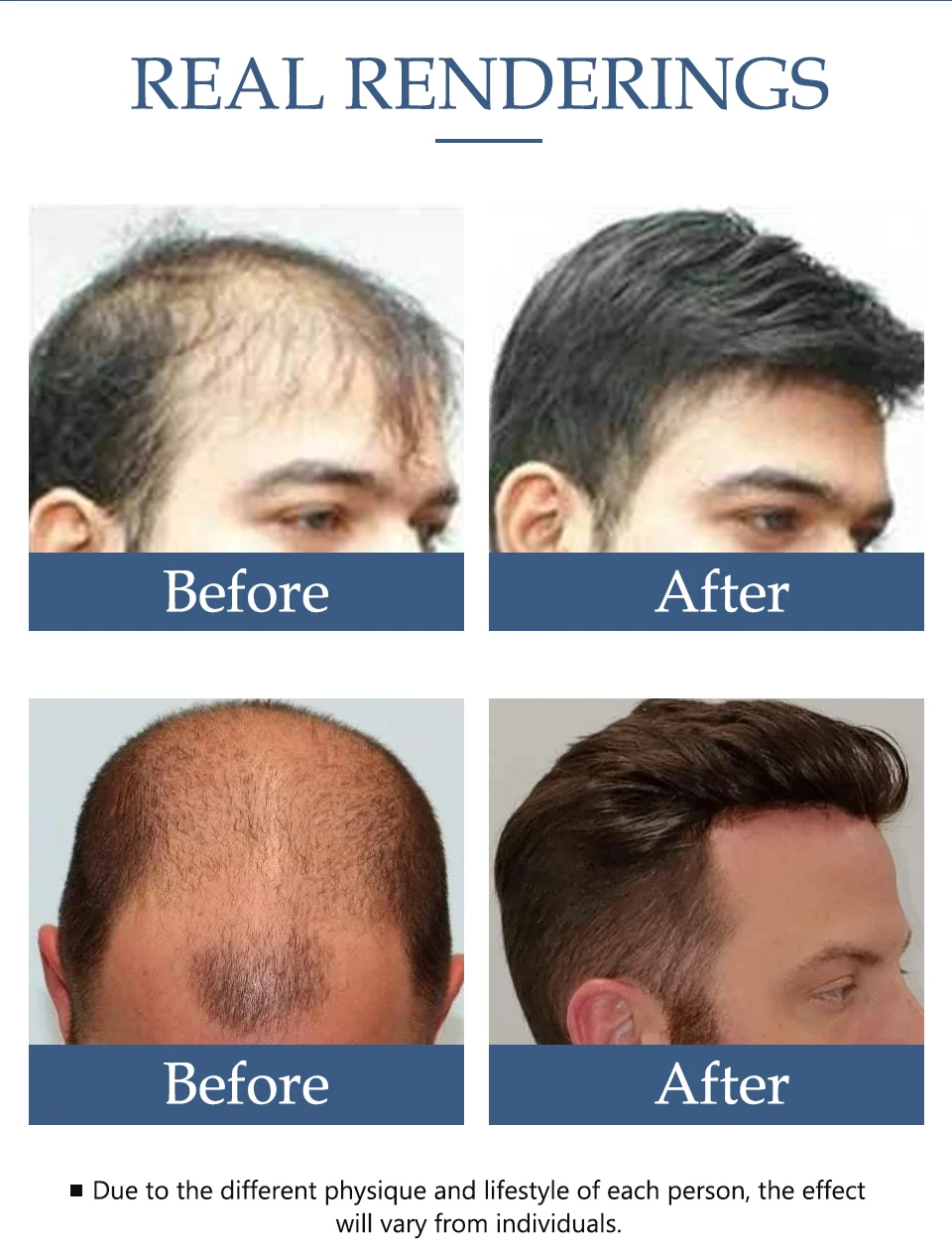 Hair Growth Essence Oil Anti Hair Loss Products for Hair Growth Treatment Genger Natural Serum Hair Thickener Care Solutions