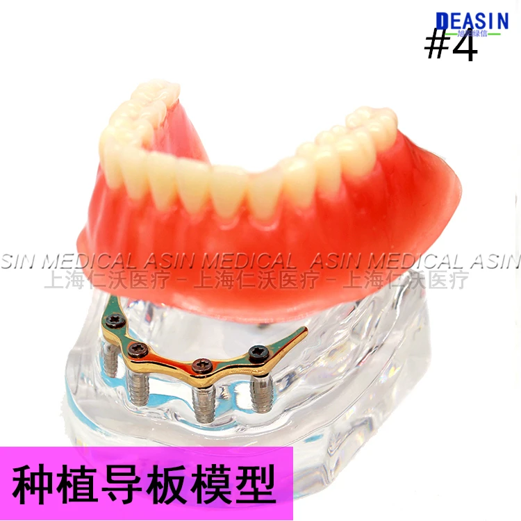 1 pc x high quality Resin Coverage dental implant model dentures Removable teeth for dentist study Deasin |