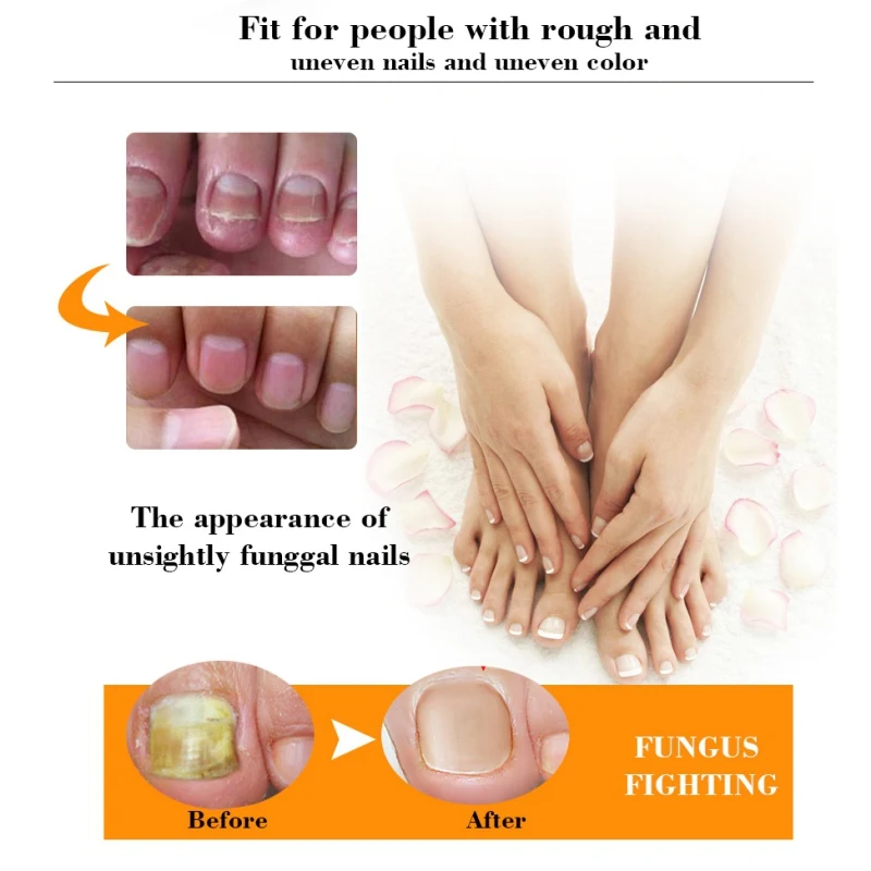 Nail Treatment Repair Gel Growth Product Remove Onychomycosis Broken Treatments | Красота и здоровье