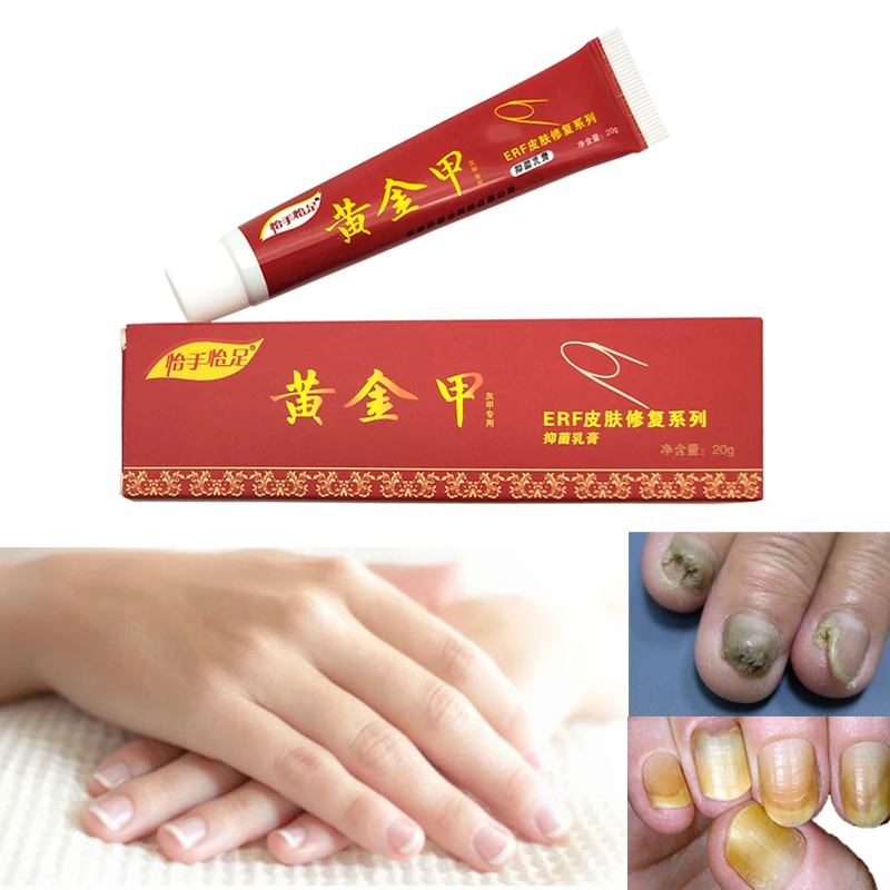 Chinese Medicine Plaster Nail Treatment Cream Onychomycosis Anti Fungal Infection Fights Bacteria Naturally ointment | Красота и
