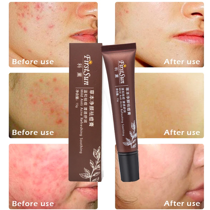 Против акне удаление шрамов лечение Осветляющий крем для лица отбеливающий