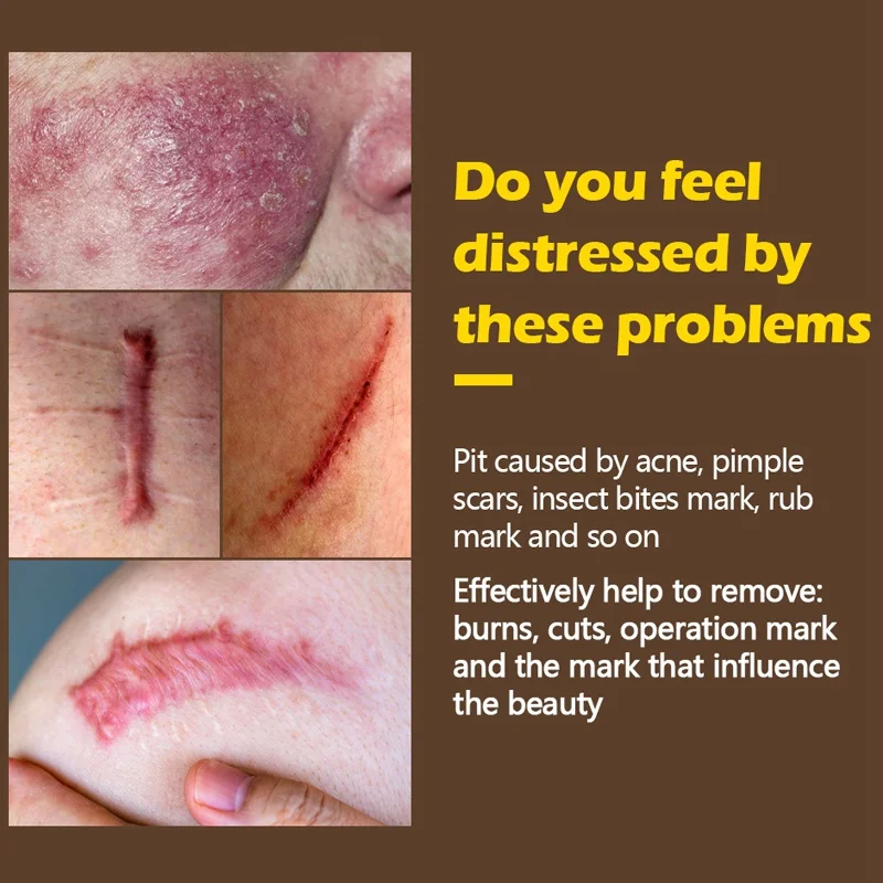 

Scar Removal Face Body Creams Repair Scar Skin Care Acne Treatment Marks Cream