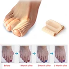 Забота о ногах, специальные исправление вальгусной деформации первого пальца стопы ортопедические брекеты правильный ежедневно силиконовые принадлежности для профессионалов педикюр инструменты
