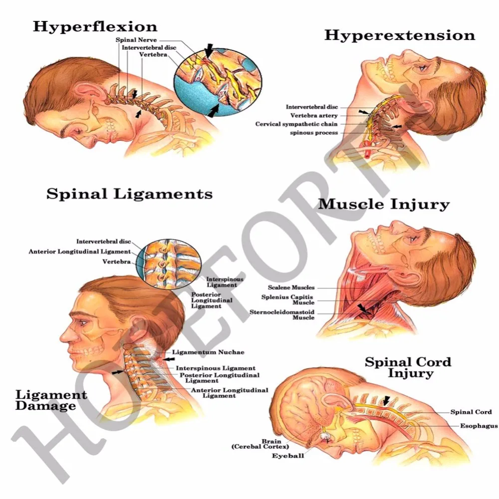 Hopeforth шейки матки над дверью массажер для шеи комплект устройства Носилки