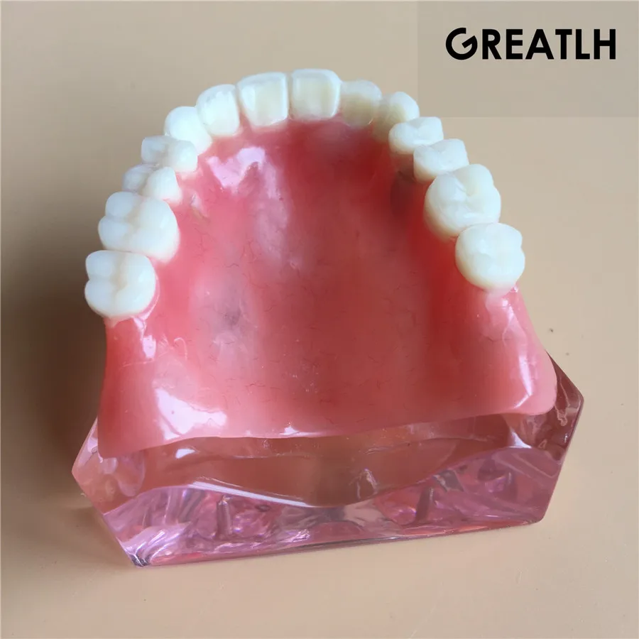 Модель зубного имплантата зубные зубы модель|dental tooth|teeth modeltooth teeth |