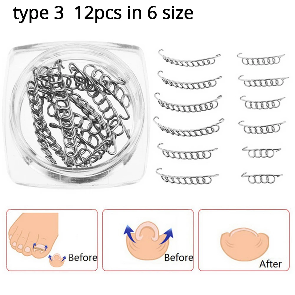 12/6Pcs/Box Ingrown Toenail Correction Wire Fixer pedicure Recover Paronychia Acronyx Onyxis Bunion Corrector Foot Care Tools | Красота и