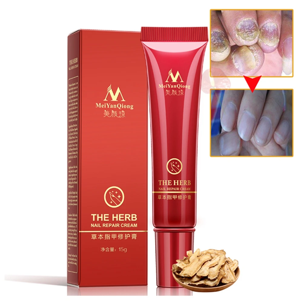 Ремонт ногтей травяной крем для грибок Лечение Onychomycosis Paronychia анти
