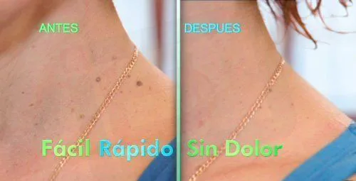 Новое избавление от бородавок быстро Удаление Pro лица генитальных естественное