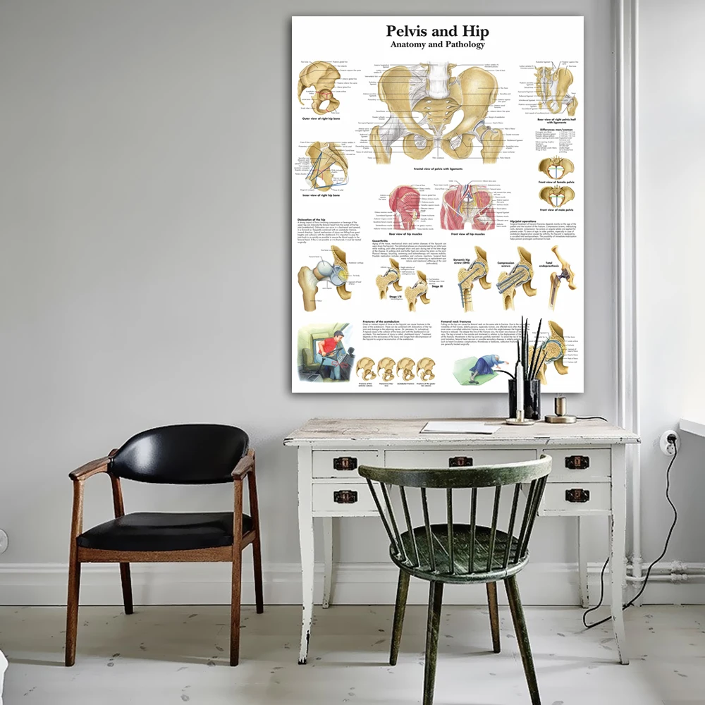 WANGART таз и бедра диаграмма анатомии патологии плакат печать на холсте настенные