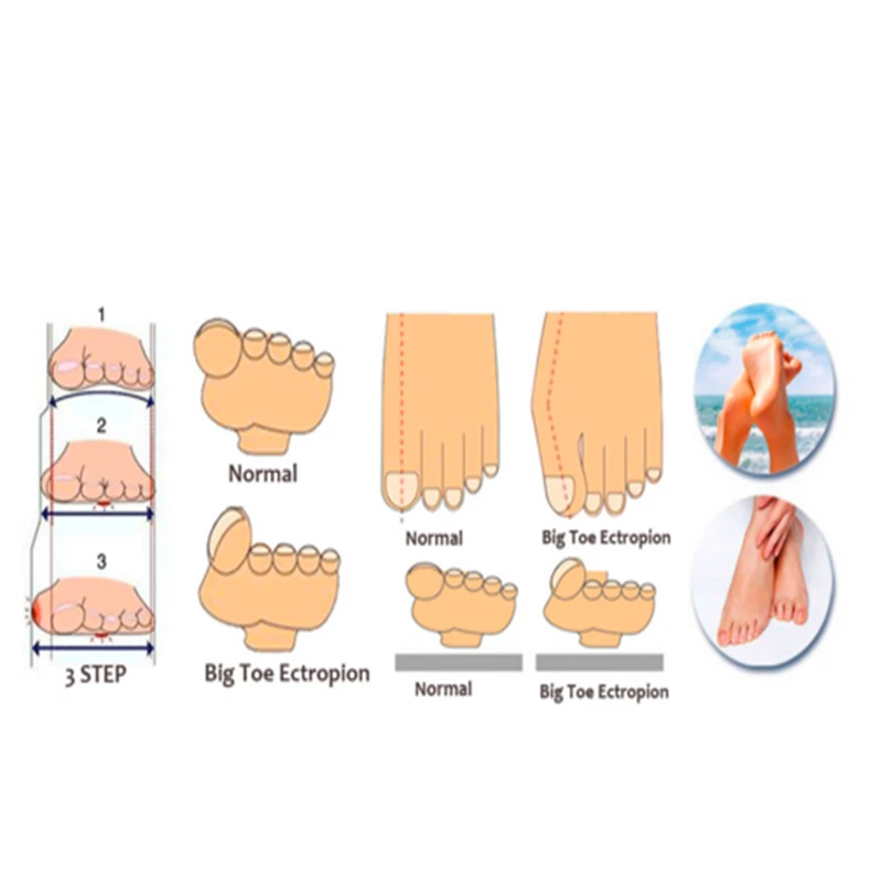 1 пара забота о ногах два отверстия силиконовые исправить большого пальца ноги
