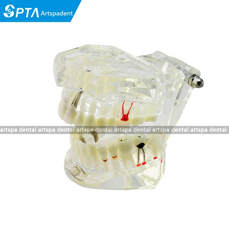 

SPTA Dental Implant Disease Teeth Can Remove Model Restoration & Bridge Tooth Ideal Medical