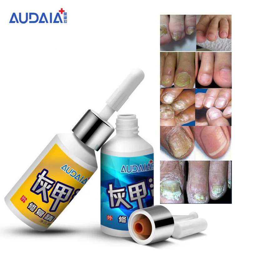 2 шт Масло отбеливающее для лечение грибка на руках и ногах | Красота здоровье