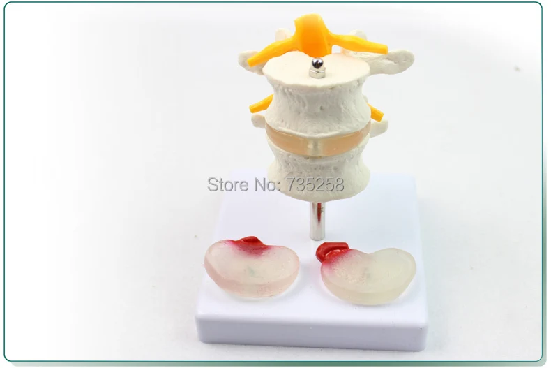 

Human Lumbar Disease Model