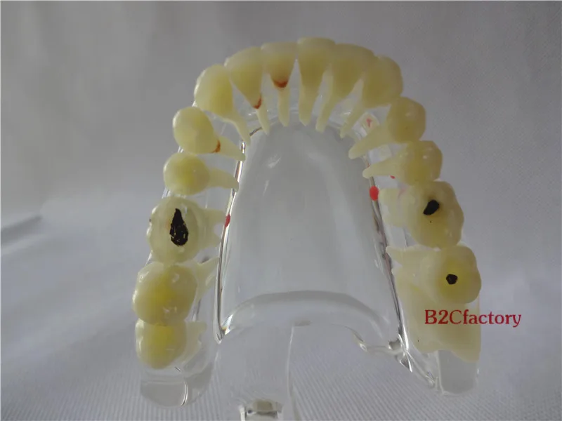 Зубной имплантат болезни зубов патологической экструзии недостающих Модель