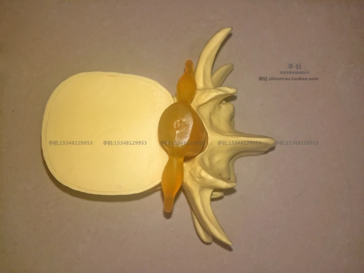 Медицинский Поясничный позвонка модель поражения нормальном состоянии CMAM VERTEBRA12