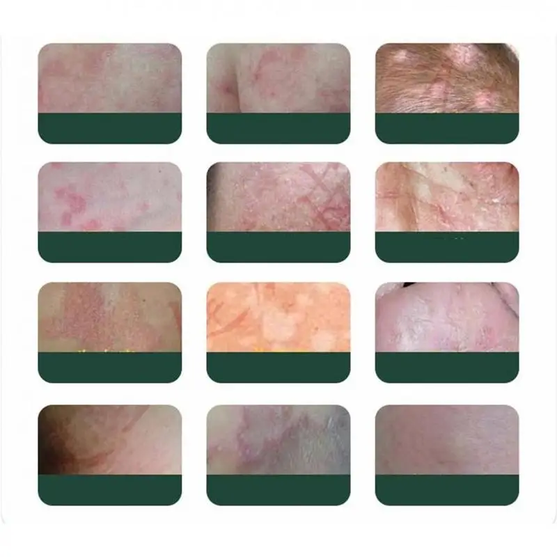 1 шт. псориаз мазь Китайский травяной дерматит экзема зуд крем Прямая