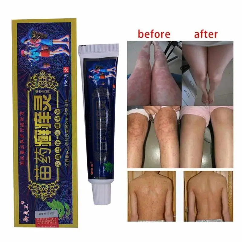 

10pcs Bacteriostatic Psoriasis Cream Dermatitis Eczematoid Eczema Ointment Treatment Psoriasis itching Cream Skin Care Dropship