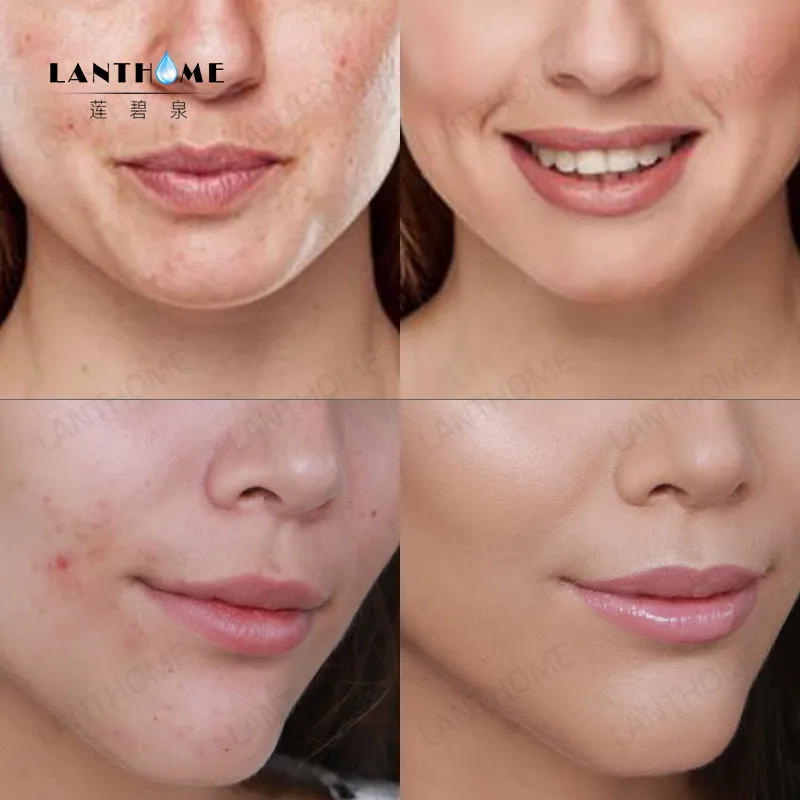 Крем для ухода за кожей лица от прыщей и прыщей|Дневные крема увлажнители| |