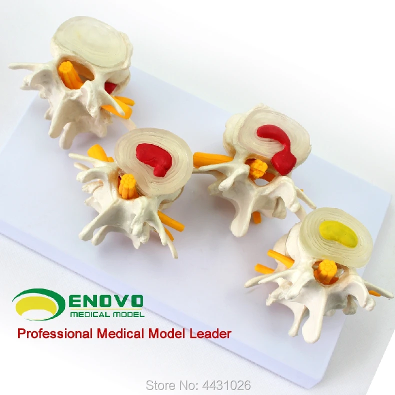 

ENOVO A model of bone pain in the intervertebral disc of the lumbar spine